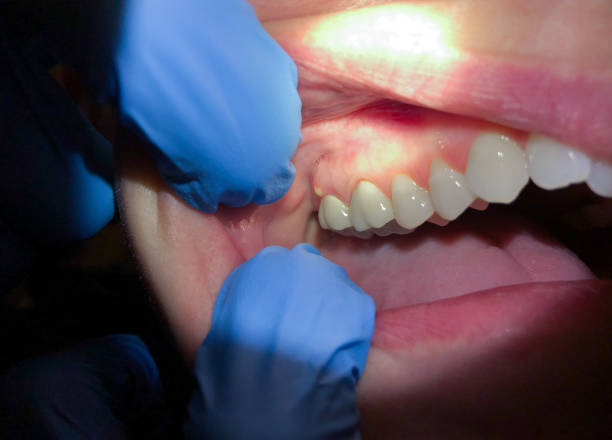 Best Broken or Cracked Tooth Emergency Dentist in Troy, AL